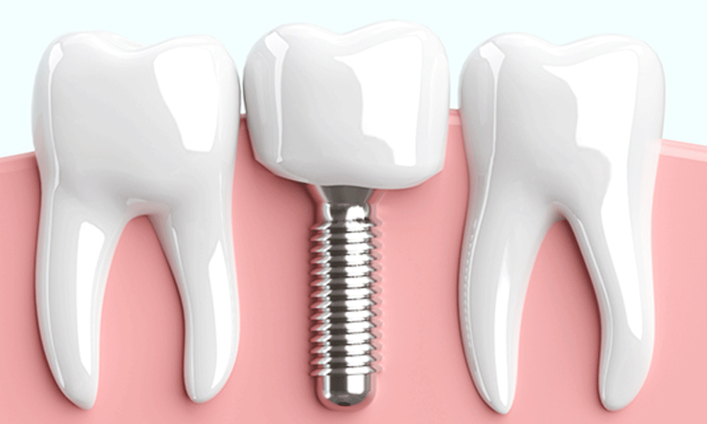 手術用マウスピースで安全にインプラントを埋入